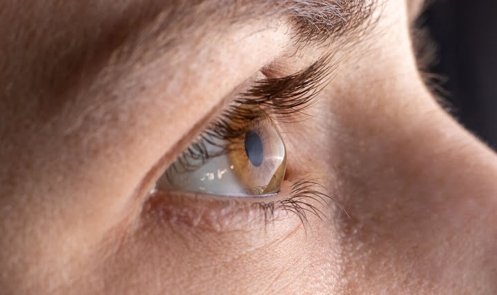 عملية زراعة القرنية